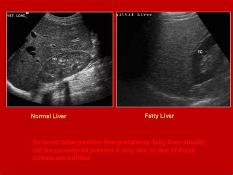 Fatty Liver Cirrhosis Ultrasound - Herbs and Food Recipes