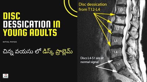 Disc Degeneration L5 S1, Disc Desiccation, Disc Degeneration Causes, DDD-Degenerative Disc ...