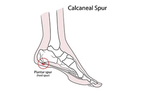 Causes and Symptoms of Heel Spurs