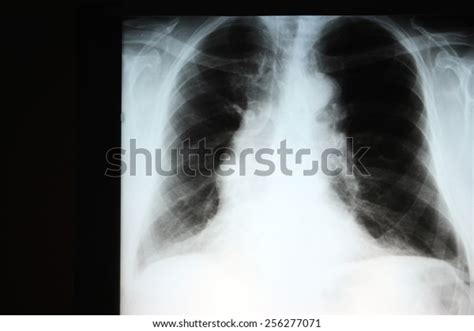 Chest Xray Showing Hyperinflation Lungs Compatible Stock Photo (Edit Now) 256277071