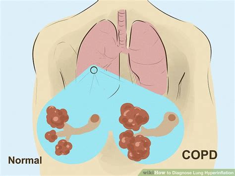 How to Diagnose Lung Hyperinflation: 10 Steps (with Pictures)