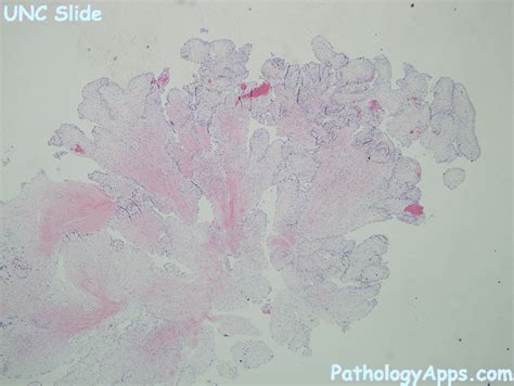 papillary fibroelastoma heart histology