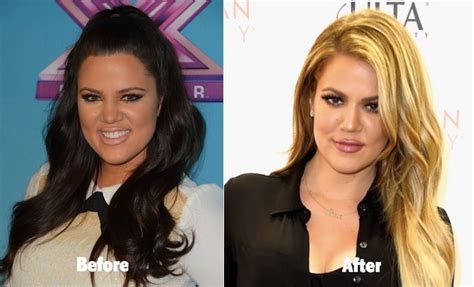 Khloe Kardashian Before and After Plastic Surgery Butt Lift Botox