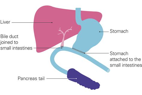 Types of surgery for pancreatic cancer - Pancreatic Cancer UK