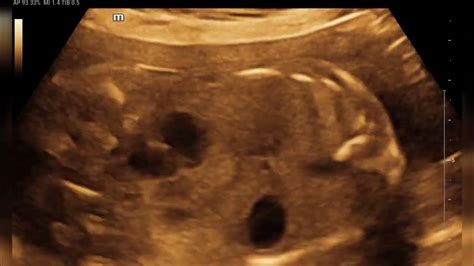 multicystic pelvic malrotated kidney fetal ultrasound - YouTube