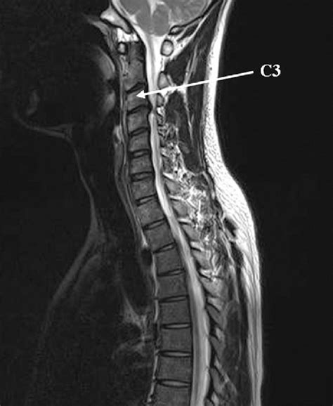 Preoperative MRI showing prolapsed intervertebral disc at the C3/4 ...