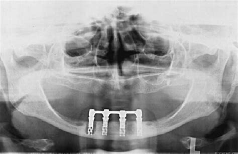 Panoramic radiograph of the implant system 10 years after implant ...