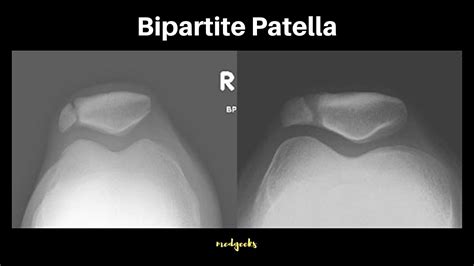 Bipartite Patella - YouTube