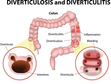 The Best Diverticulitis Diet: Splitting Fact From Fiction | Diet vs Disease