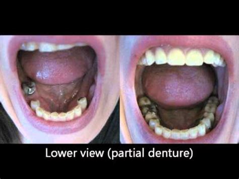 Before and after dentures - YouTube