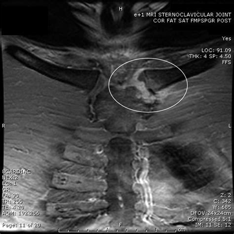 Sternoclavicular Joint Arthritis