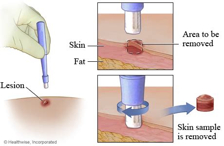 Punch Biopsy | Nurses Zone | Source of Resources for Nurses