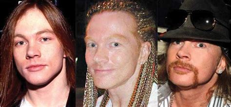 Axl Rose Plastic Surgery Before and After Pictures 2021