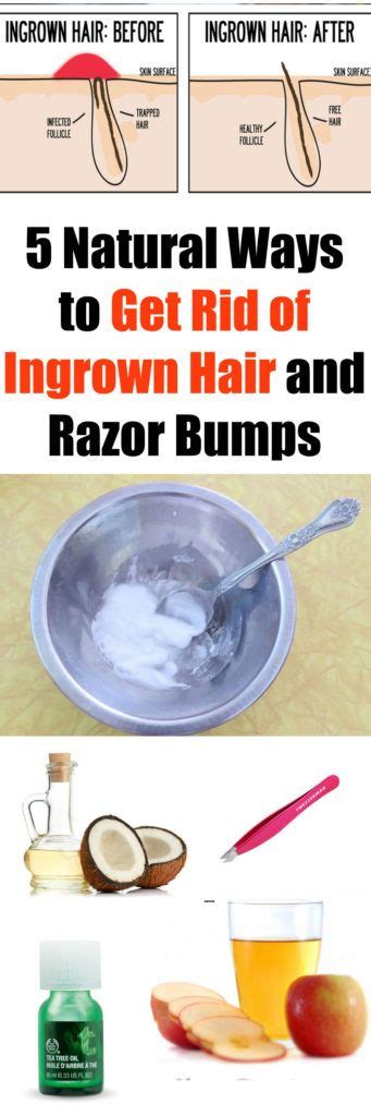 5 WAYS TO GET RID OF INGROWN HAIR OR RAZOR BUMPS | Ingrown hair, Ingrown hair bump, Ingrown hair ...