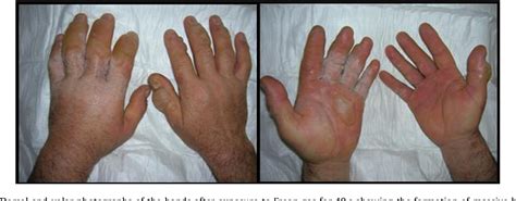 Figure 3 from Unusual both hands cryogenic burn caused by Freon gas and ...