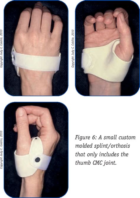 Figure 1 from A New Splint Design for the Thumb CMC Joint | Semantic Scholar