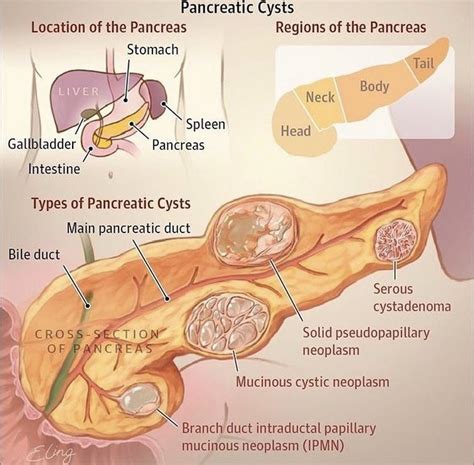 Quistes Pancreaticos | Diagnostic medical sonography, Medical anatomy, Medical knowledge