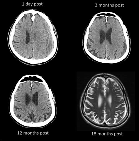 Subdural MMA Embolization Via Collaterals Remote Pterional Craniotomy Follow Up | neuroangio.org