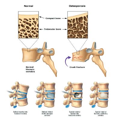 Compression Fractures_Pain Management Group - The Pain Management Group