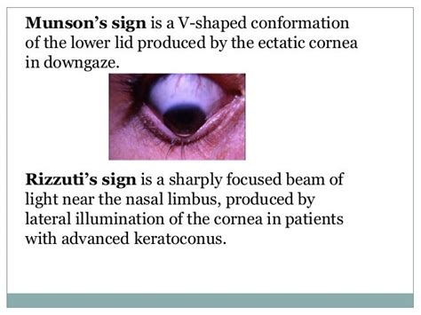 Keratoconus