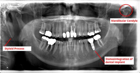 Submandibular Fossa Radiograph