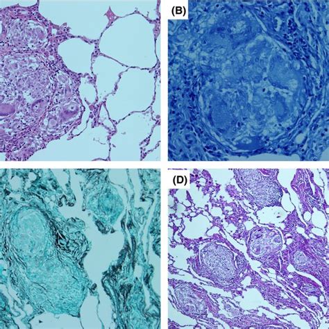 Histopathology of resected lung tissue. A, noncaseous granuloma ...