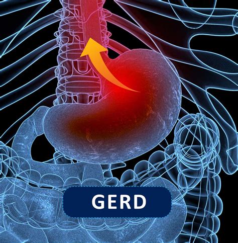 46+ Gastroesophageal Reflux Disease Or Gerd Background - GERD ...