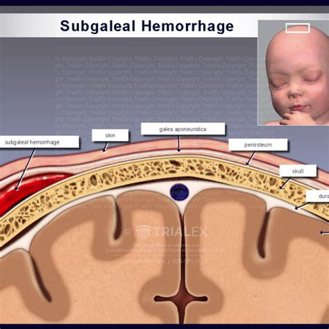 Subgaleal hemorrhage - TrialExhibits Inc.