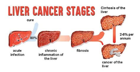 Liver Cancer - Types, Symptoms, Causes And Treatments