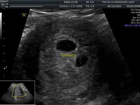 Twins Ultrasound 6 Weeks