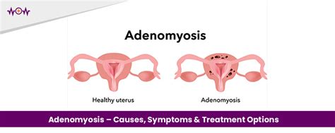 Adenomyosis - Causes, Symptoms & Treatment - WoW Health