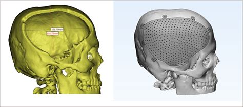 Cranial Implants - 3DIncredible