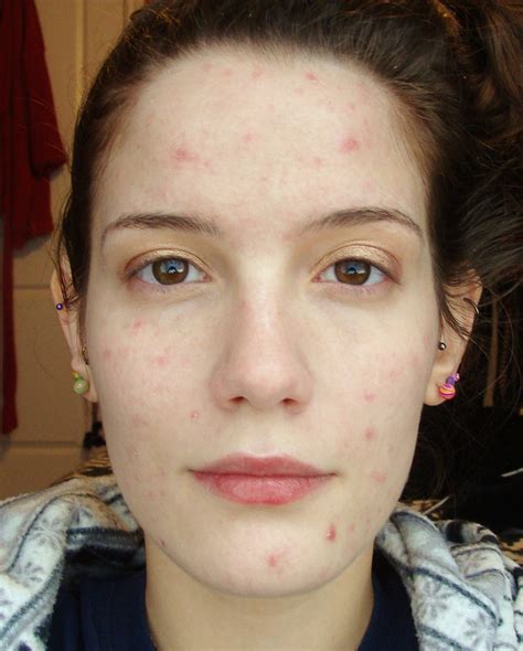 mild acne - pictures, photos