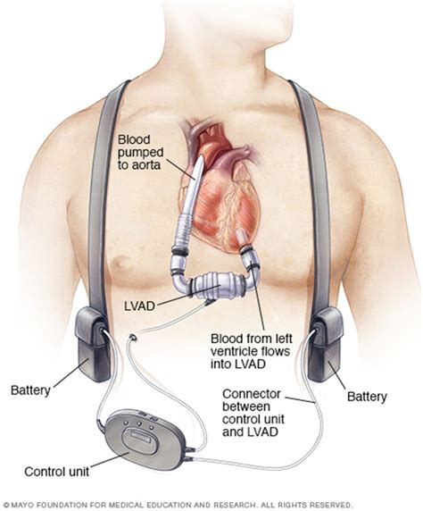 PV Card: LVAD Complications