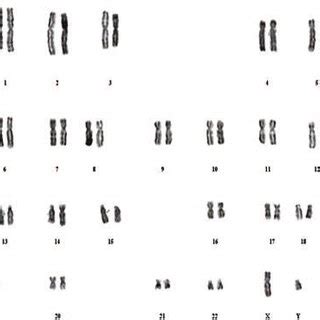 Karyogram of a Down Syndrome (DS) male patient showing translocation,... | Download Scientific ...