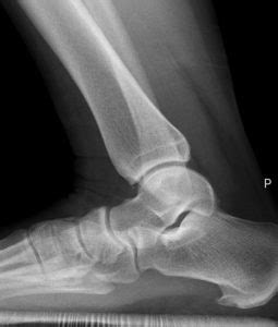 Anterior Ankle Impingement - Ankle, Foot and Orthotic Centre