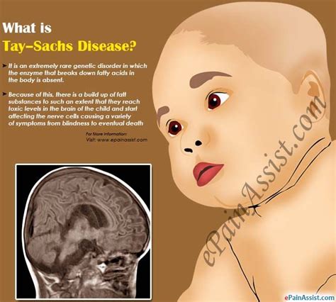 What is Tay–Sachs Disease? | Genetic disorders, Disease, Icu nursing