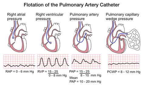 PA catheter, Pressures Cath Lab Nursing, Nursing Tips, Nursing Study ...