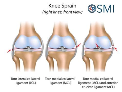 Five Common Knee Injury Symptoms - The Orthopedic & Sports Medicine ...