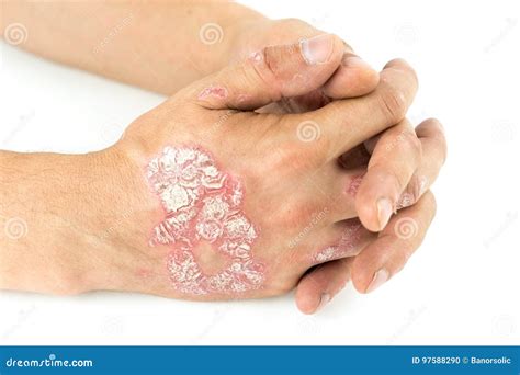 Psoriasis Vulgaris on the Male Hands with Plaque, Rash and Patches, Isolated on White Background ...