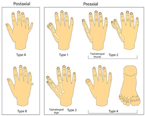 Hand Malformations » Division of Genetics and Metabolism » College of ...