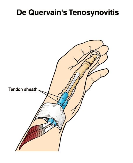 DEQUERVAIN’S TENOSYNOVITIS | Pain Prevent