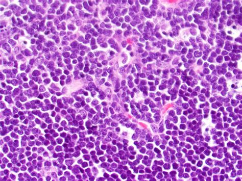 Acute Lymphoblastic Leukemia Bone Marrow