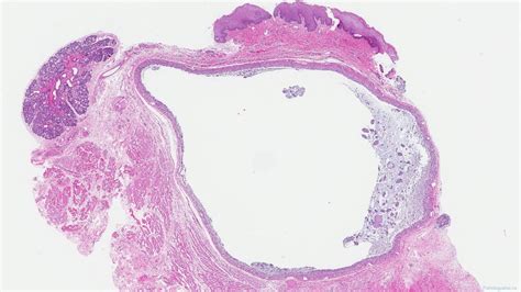 Mucocele Histology