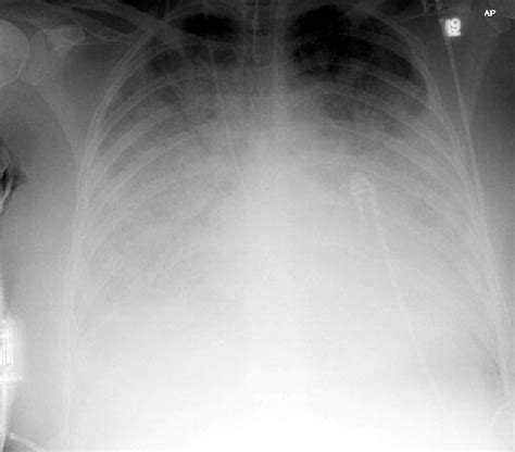 Chest Medicine Made Easy-Dr Deepu: Air Bronchogram Sign.