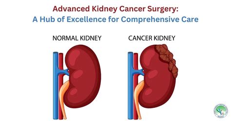 Advanced Kidney Cancer Surgery: A Hub of Excellence for...