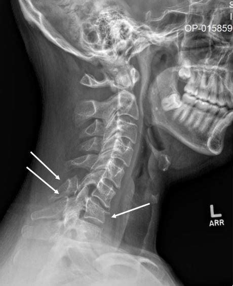 Spinous Process Fracture