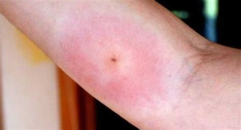 Home Remedies for Spider Bites Treatment