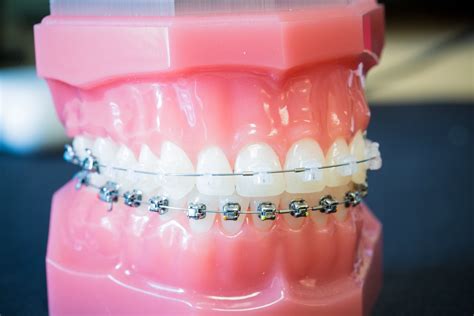 Clear Braces - Ceramic Braces - Colonial Heights, VA