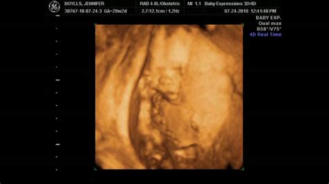 Aiden 20 Weeks 3D 4D Ultrasound pt3 - YouTube